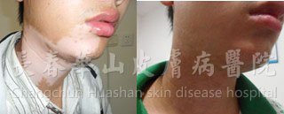 20岁青少年颈部白癜风15年