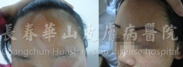 27岁女性面部白癜风1年半